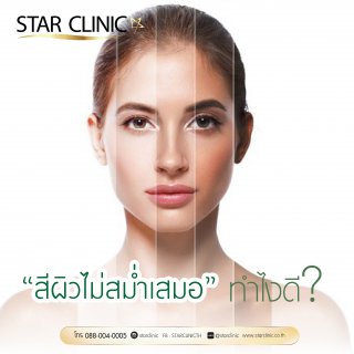 สีผิวไม่สม่ำเสมอ ทำไงดี!?