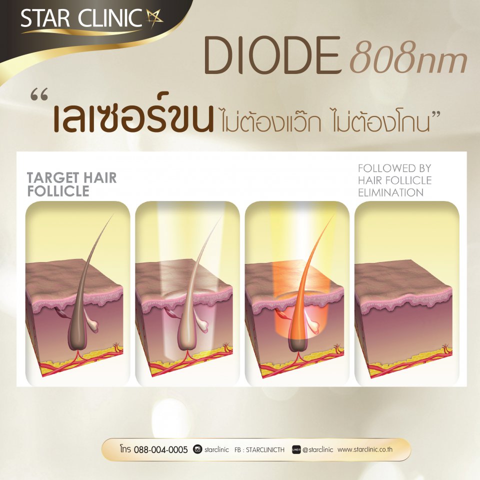 diode 808 nm กำจัดขนด้วยเลเซอร์ไดโอด