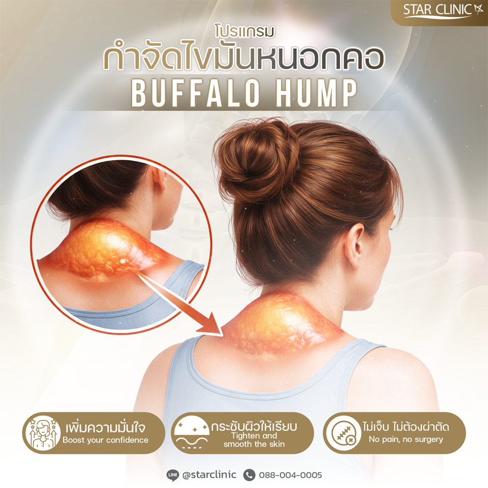 Buffalo Hump Fat Removal Program