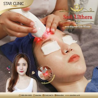 Soft Ulthera Review